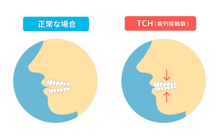歯ぎしり・食いしばりとは？