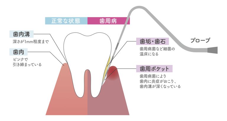 歯周病とは？